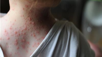 منظمة الصحة العالمية: 257 إصابة مؤكدة بجدري القرود في 23 دولة حتى الآن